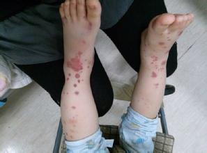 过敏性紫癜出血点症状,过敏性紫癜的症状出血时间正常