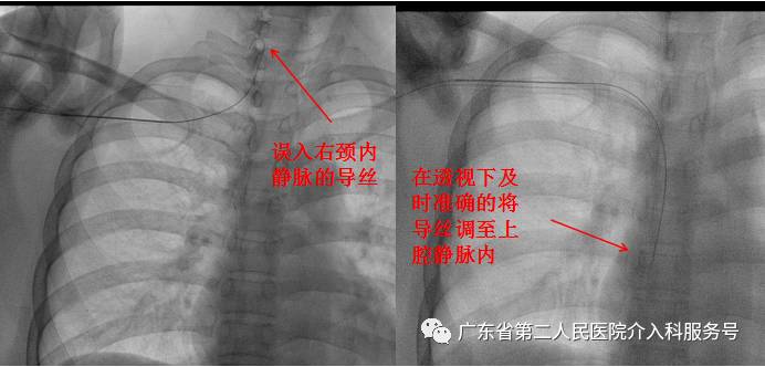 输液港能多次做吗,输液港可以重复使用吗