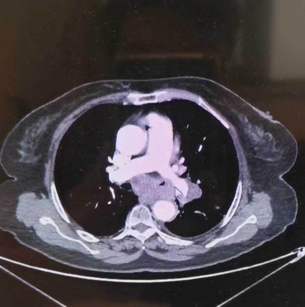 80岁得癌症放弃治疗,80岁以上肺癌建议手术吗