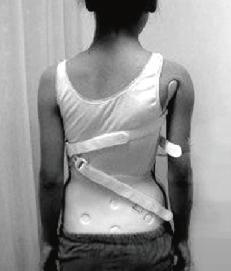 怎么知道脊柱侧弯的危害和症状,造成脊柱侧弯的原因主要是什么