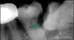 上颌埋伏阻生牙拔除多久能矫正,水平阻生埋伏牙真实拔除过程
