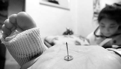 儿童手指夹伤怎么处理,三岁女童手指被压断后续