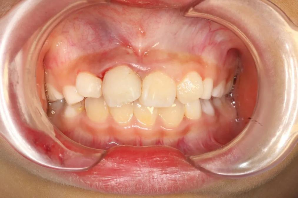 小孩牙断了露出牙神经该怎么处理,孩子牙断了牙根在里面要不要拔