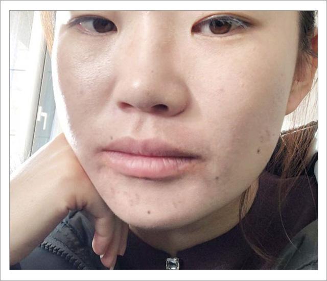 根除脸上螨虫的简单方法,螨虫在脸上如何彻底消除