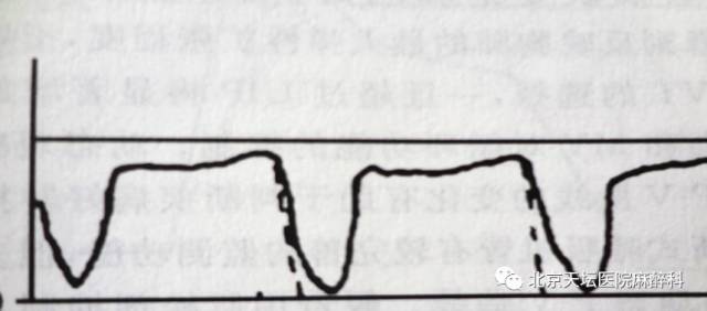 常见呼吸类型有哪几种,呼吸少量二氧化碳有什么症状