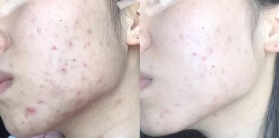 祛痘激光手术能彻底把痘痘去除吗,脸上痘痘太多做什么医美不伤皮肤