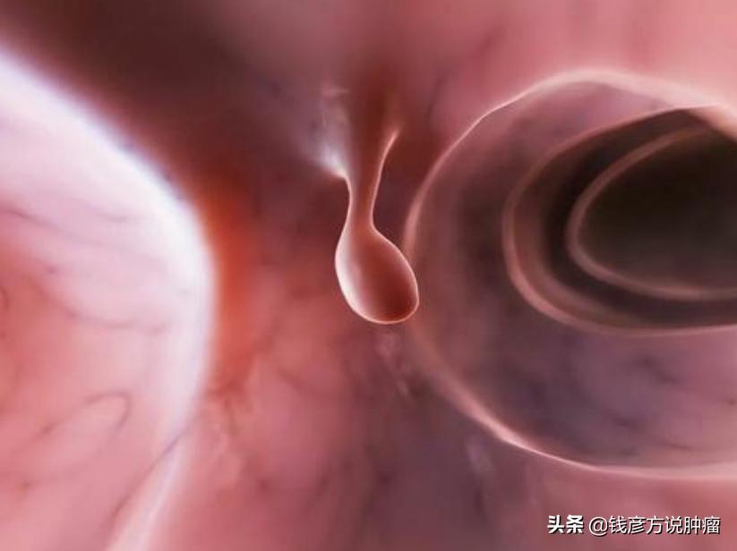 结节息肉能根治吗,结节息肉最佳治疗方案