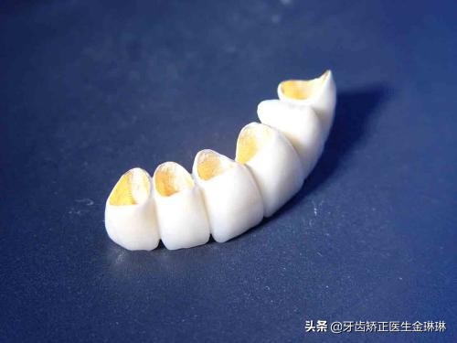 全明星都在做的烤瓷牙真的好吗,为什么明星全瓷牙要几百万