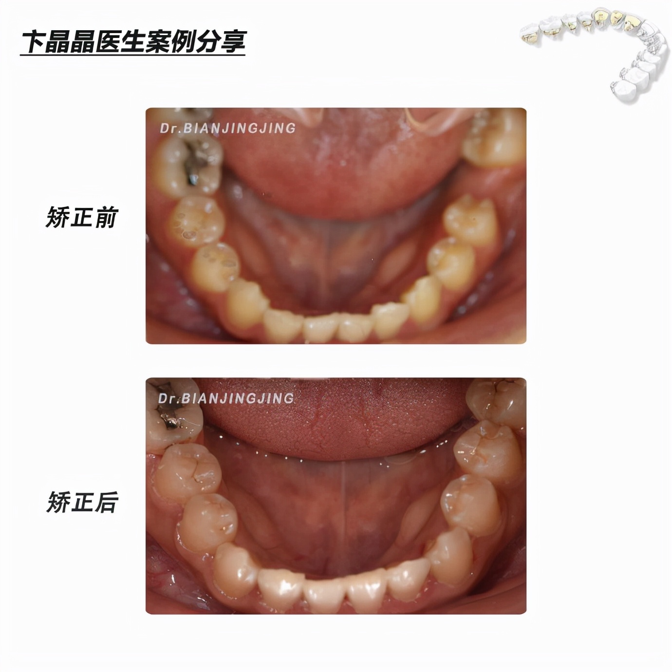 沈阳矫正牙齿大概多久能矫正过来,沈阳牙齿代偿矫正哪里好