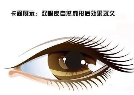 全切双眼皮肉条感重怎么修复,全切双眼皮肉条感怎么缓解