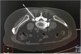 腰椎间盘突出小针刀后腰硬怎么办,腰椎间盘突出小针刀能恢复正常吗