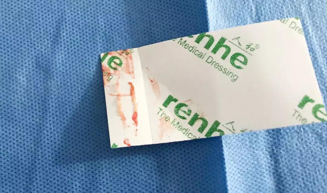 肝癌粒子植入和消融哪个好,肿瘤微波消融