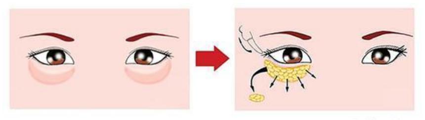 内切眼袋第6天出血,做完眼袋手术后眼睛内部出血
