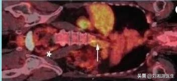系统性血管炎怀孕能要吗,怀孕得了血管炎怎么办