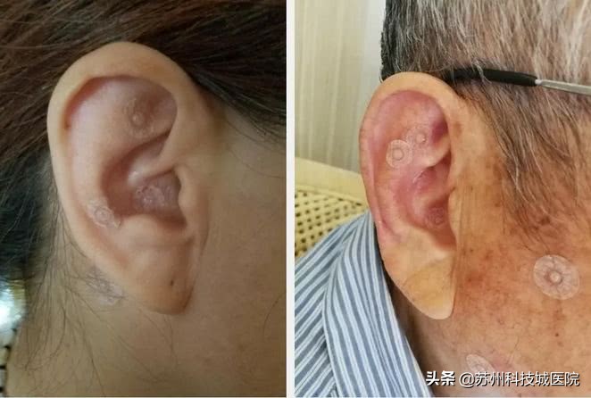 扎耳朵减肥效果好吗,耳针可以帮助减肥吗