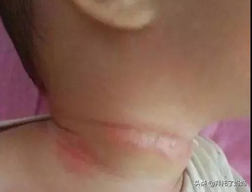 预防痱子小窍门,热痱和痱子的区别