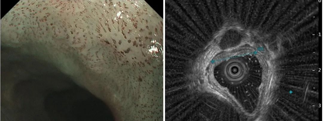 早期食管癌的病变范围是,早期食管癌手术费用多少