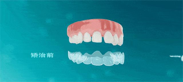 隐型矫正器和固定矫正器的区别,天使隐形矫正与隐适美矫正的区别