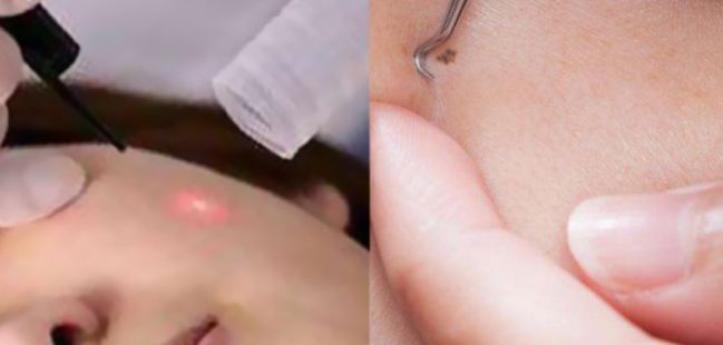 到底该不该做激光祛斑,激光点疣祛痣注意事项