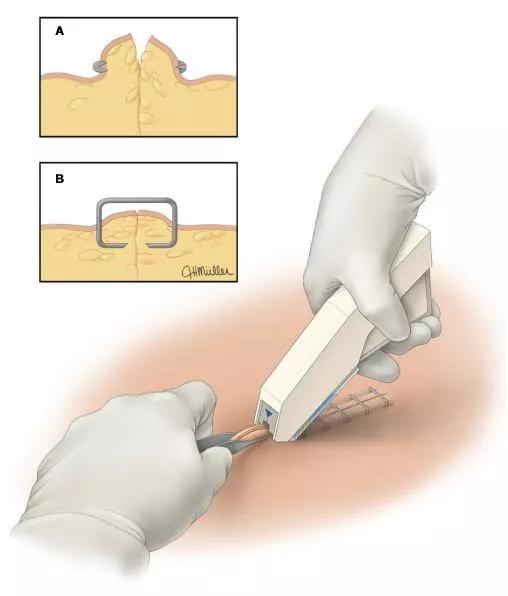 各种皮肤缝合伤口的方法对比