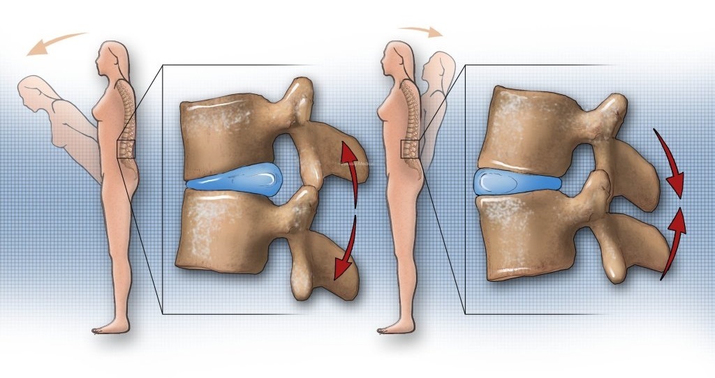 腰椎间盘突出要少运动?不宜跑步和健步走?医生:正确运动康复快