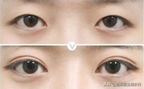 睁眼有神闭眼无痕修复双眼皮,无痕双眼皮眼尾有开口