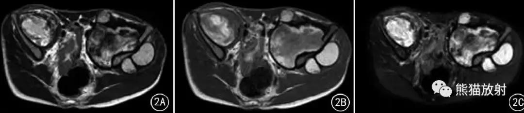 假性血友病什么症状,血友病病理