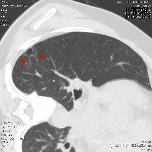 警惕-会是简单的肺大泡吗？