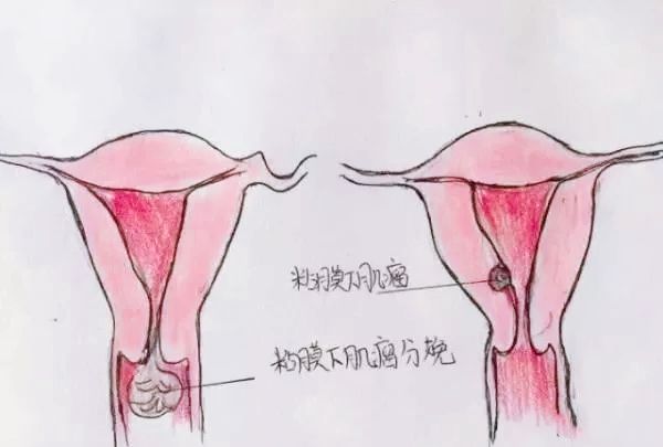 医生精美手绘图片大全,宫颈息肉红蓝铅笔手绘图