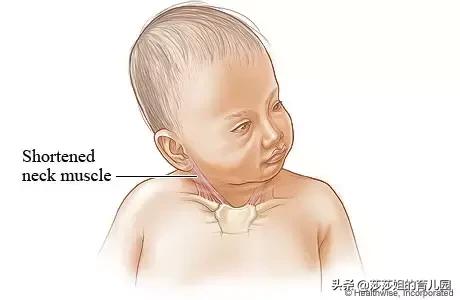 6岁的宝宝斜颈自愈最快的方法,小孩斜颈矫正又歪了