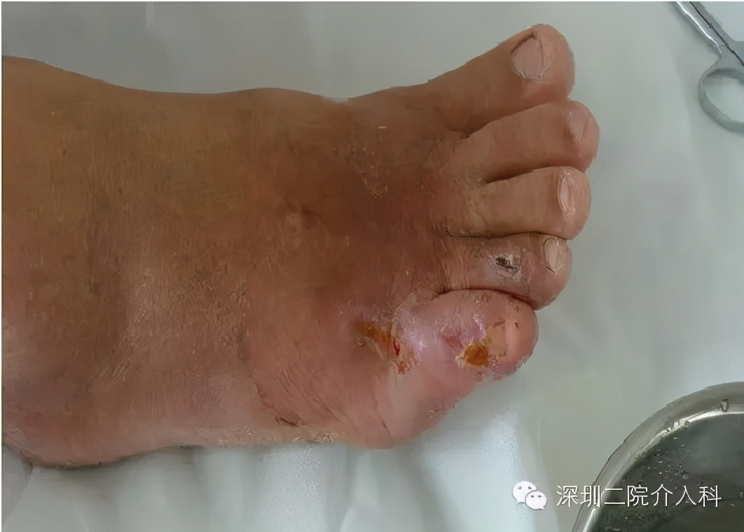 糖尿病下肢血管病变介入治疗,糖尿病足血管介入