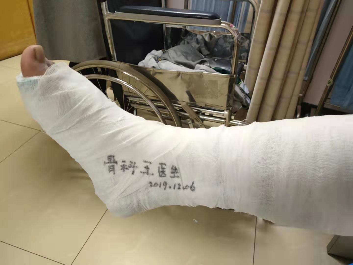 男大学生骨折打石膏,开放性骨折打石膏小男孩