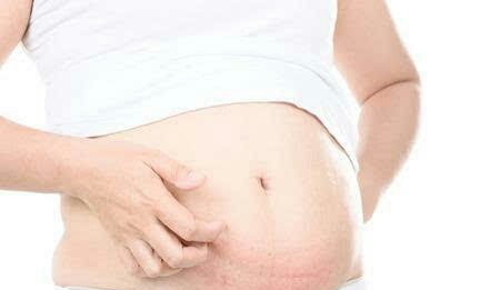 孕期肚子痒可以擦什么药膏,孕期什么办法可以缓解肚子痒