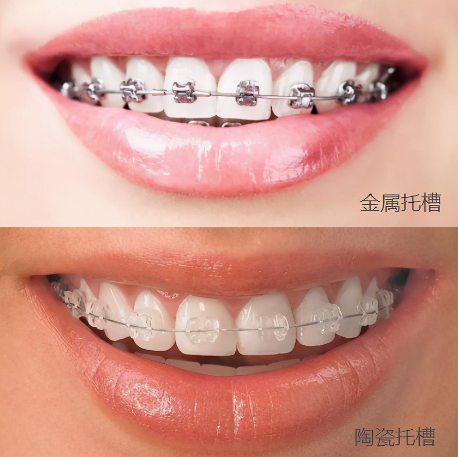 牙齿矫正黑幕素材,牙齿正畸内幕