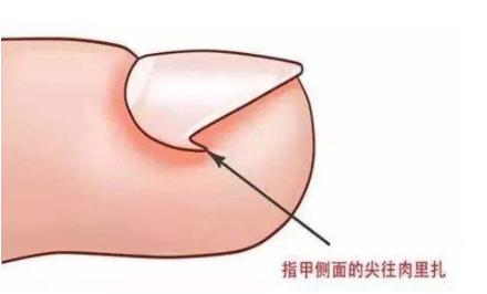 嵌甲一直不剪会怎么样,嵌甲习惯长在肉里纠正不过来