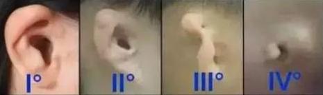 余文林博士耳朵畸形,余文林小耳畸形再造