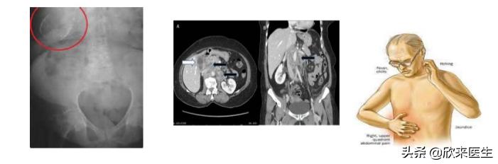 公务员入职体检胆囊息肉有影响吗,胆囊息肉要紧吗影响公务员体检吗
