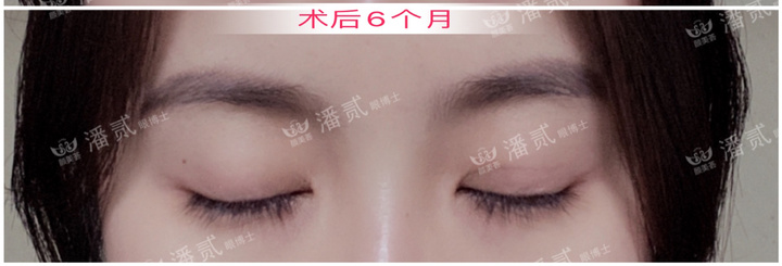 上睑下垂手术是不是永远闭不上眼,做了上睑下垂手术后怎么护理眼睛