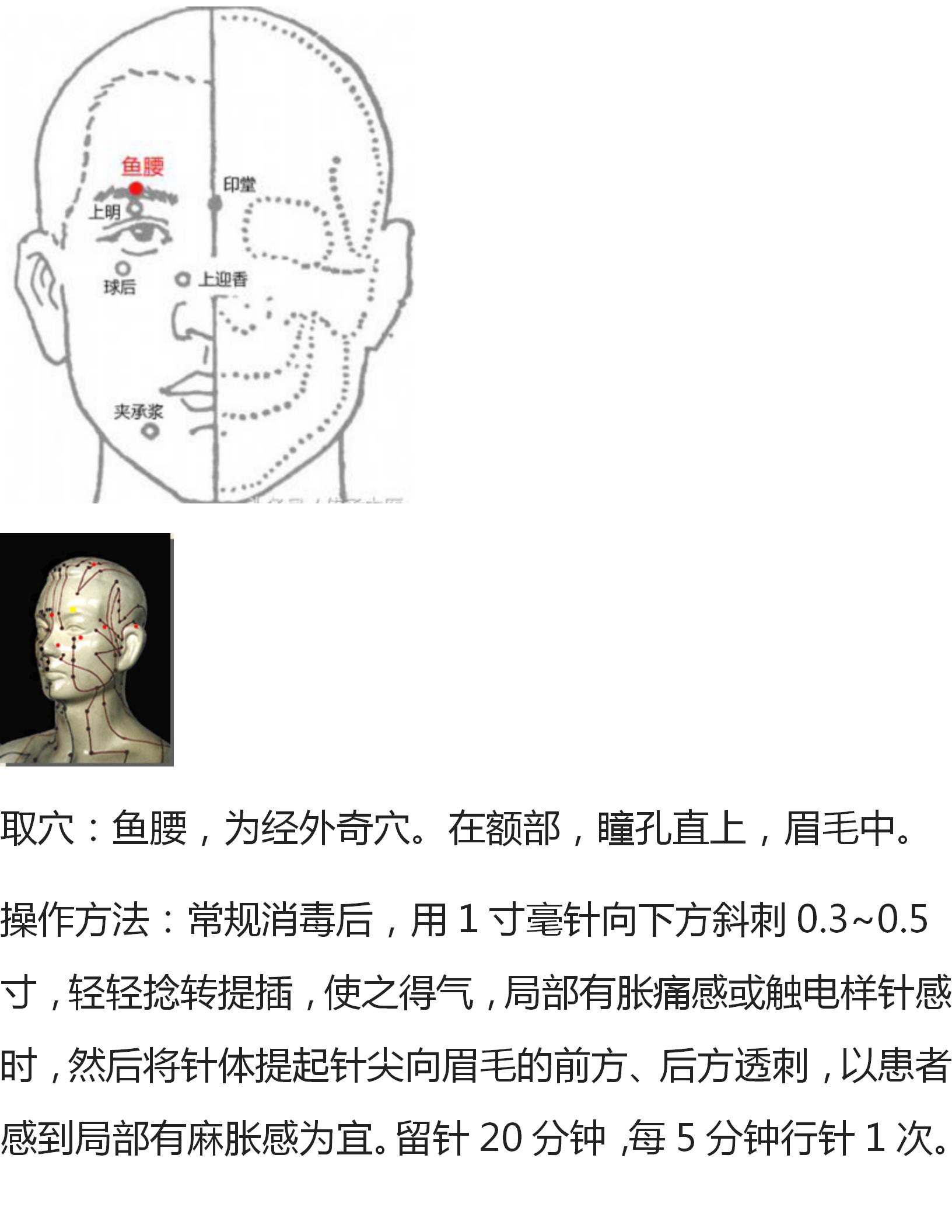 各种痛症的针灸方法,董氏奇穴大拇指腱鞘炎针灸取穴