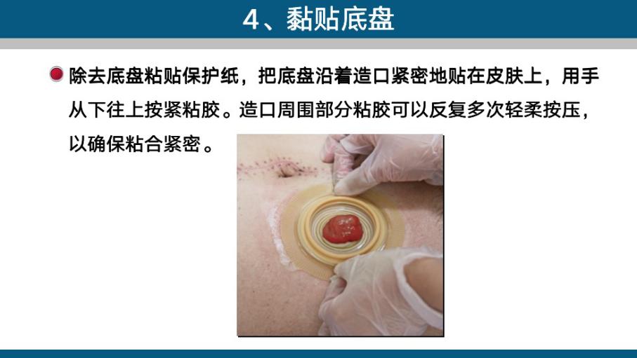 造口手术后多久复查一次,造口复查检查什么