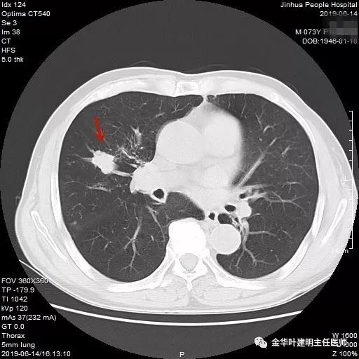 能不能手术,极重度混合性通气功能障碍能治吗