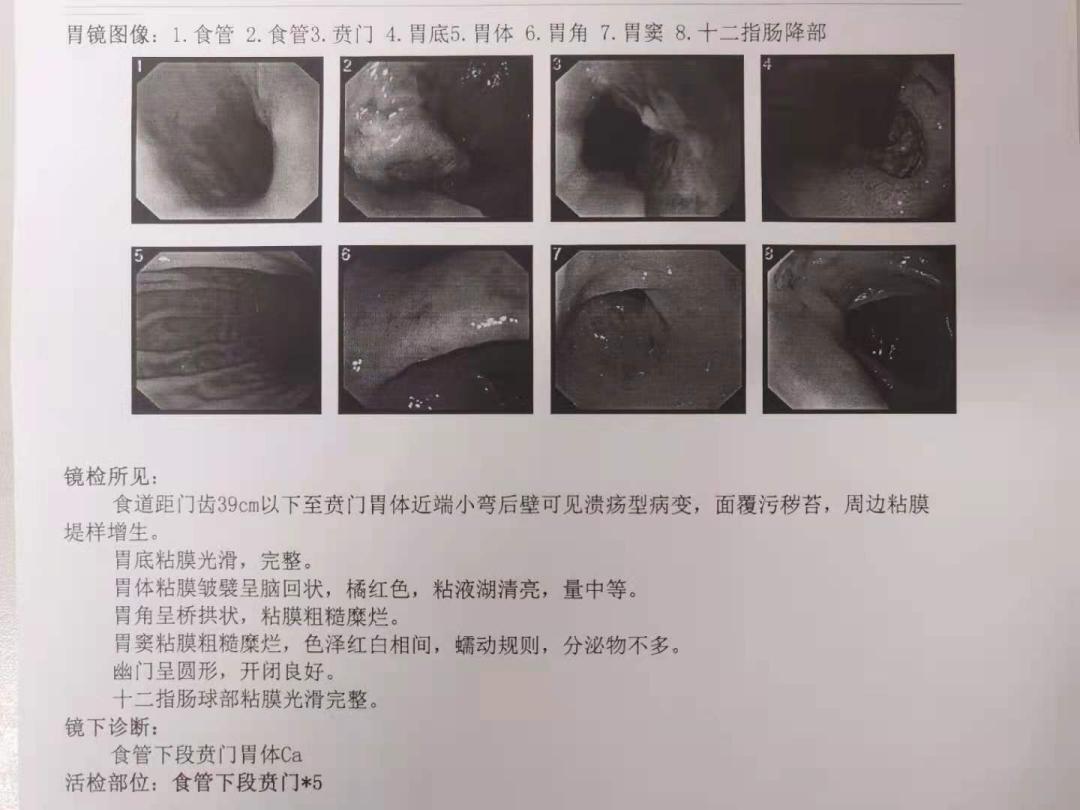 我院肝胆外科主任许其威、副主任医师兰军良团队完成一例保脾全胰十二指肠联合全胃根治性切除治疗多原发癌