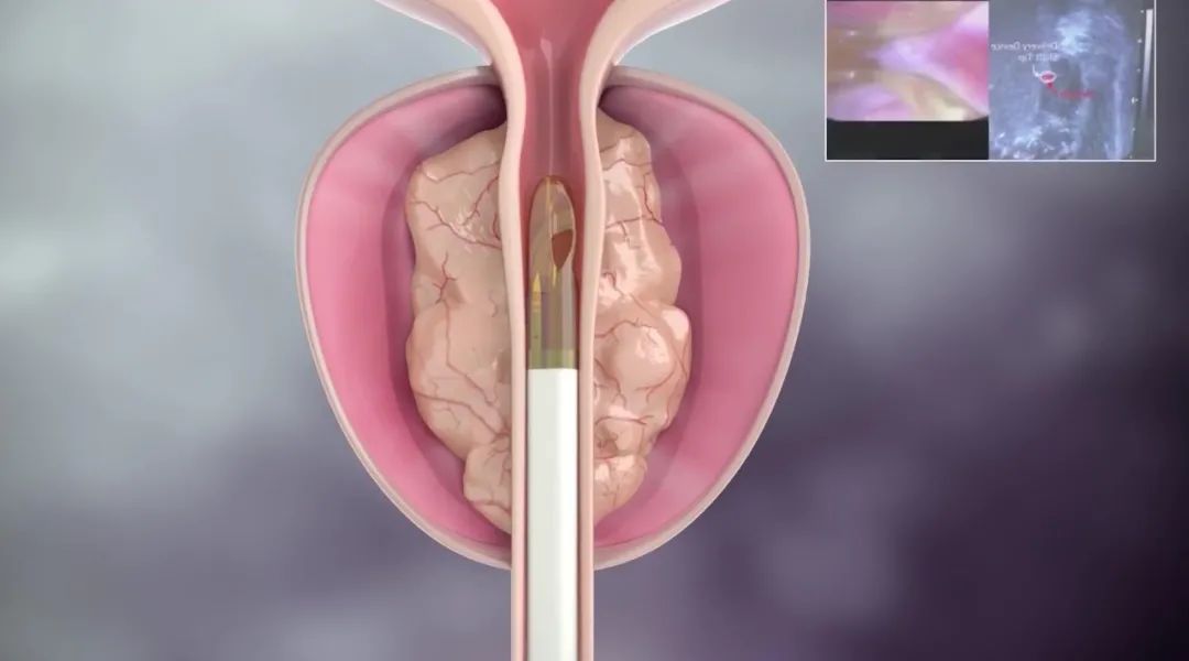 「男性健康」低能量体外冲击波（ED1000）在“男性疾病”中的应用