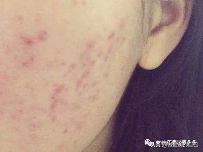 痘印长期不消怎么办,痘印反复消不下去怎么办
