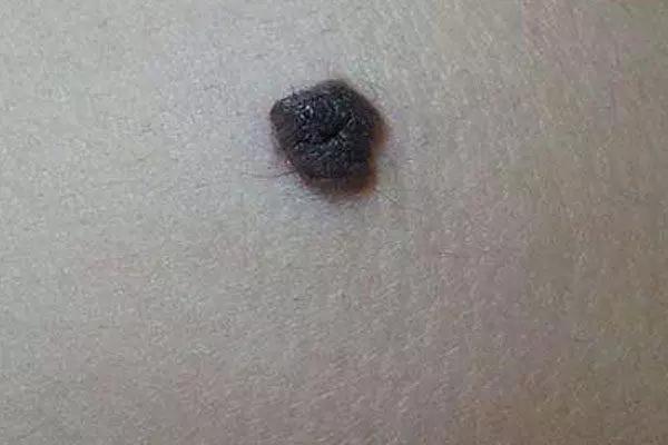 身上突然长咖啡色肉痣是咋回事,身上出现红色痣一定与肝脏有关吗