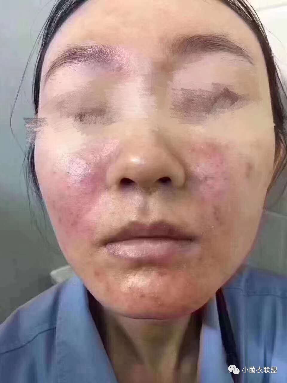 脸部红斑丘疹怎么治疗,白眼圈有个红点是怎么回事