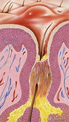 连续十年不停的长痘疮是怎么回事,身上长痘疮怎么治疗