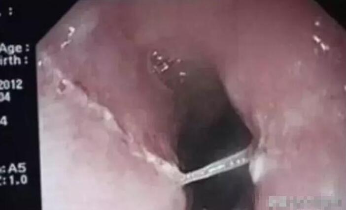 孩子被鱼刺卡住试了吐有效果吗,孩子被鱼刺卡住妈妈正确做法