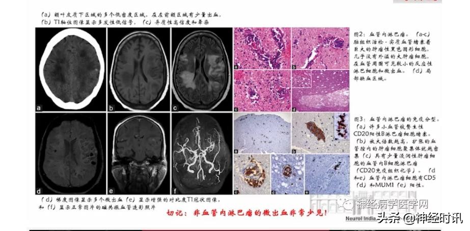 缺血性脑血管病出血评估,脑血管微出血怎么治疗