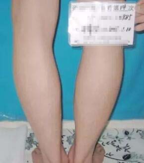 女友陪着康复,女友陪男友康复治疗